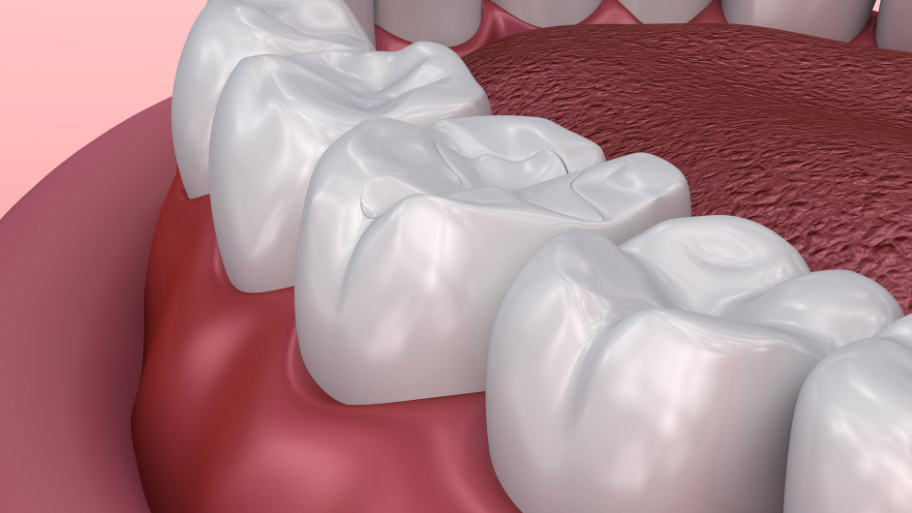 Image showing the benefits of modern dental fillings