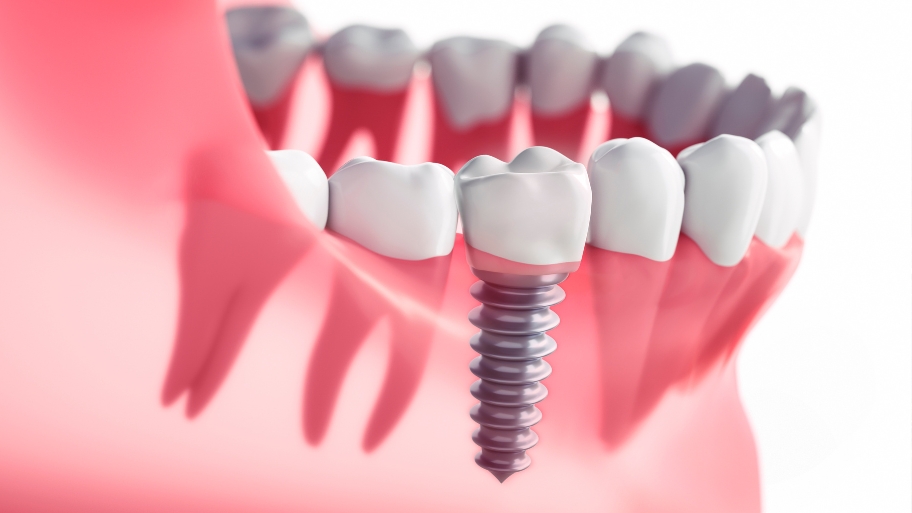 How the Dental Implant Procedure Replaces the Root of Your Missing Tooth