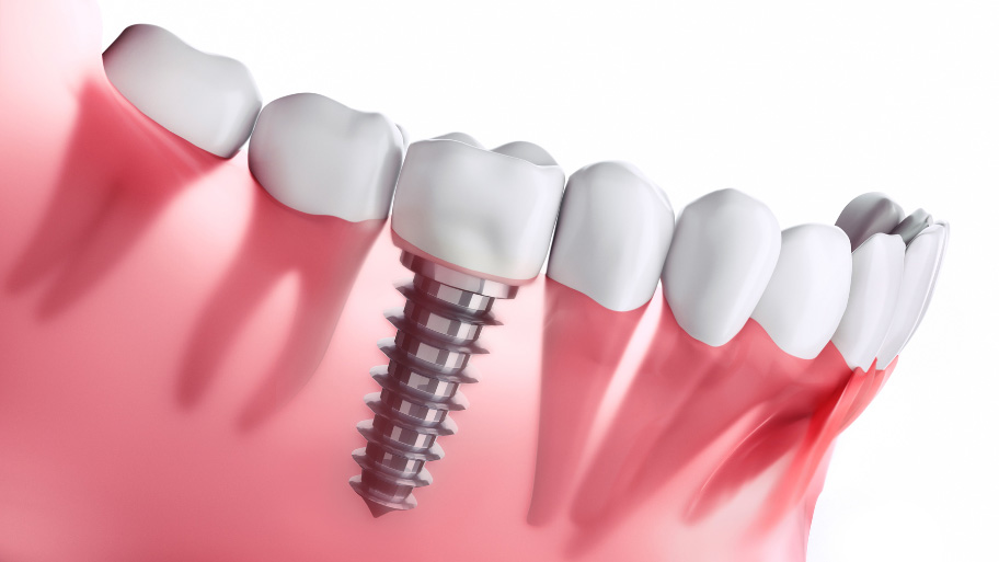 Dental Implants and Dentures