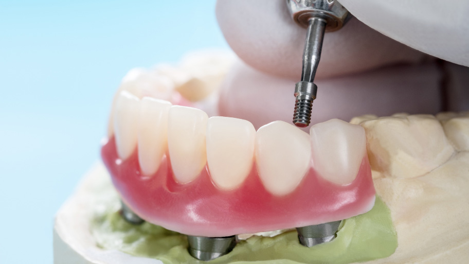 Dental implants supported overdenture.