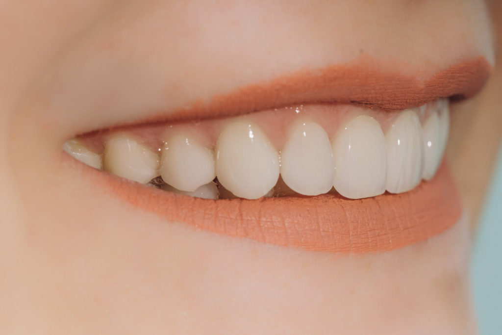 Porcelain veneers