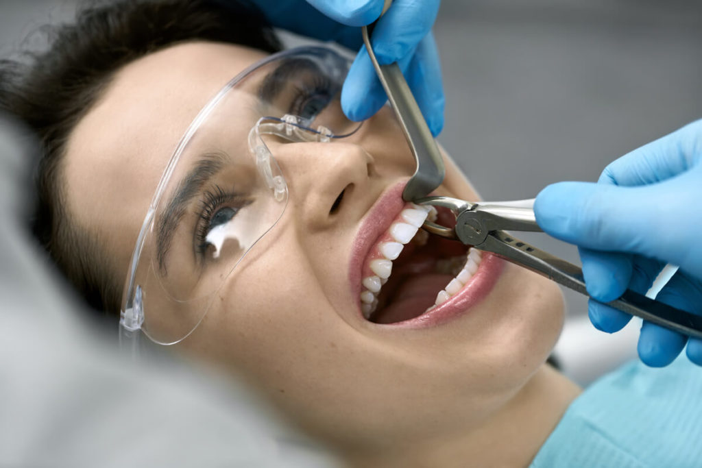 Tooth Extraction