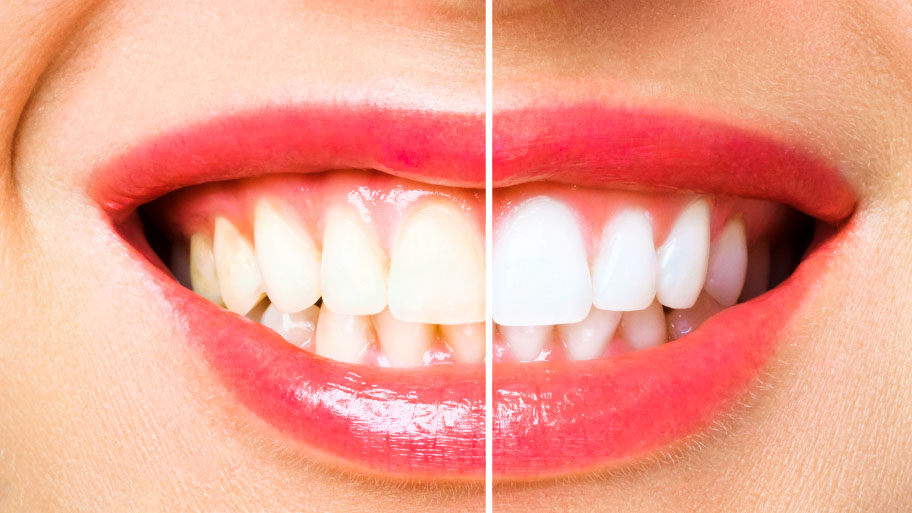 Benefits of Teeth Whitening