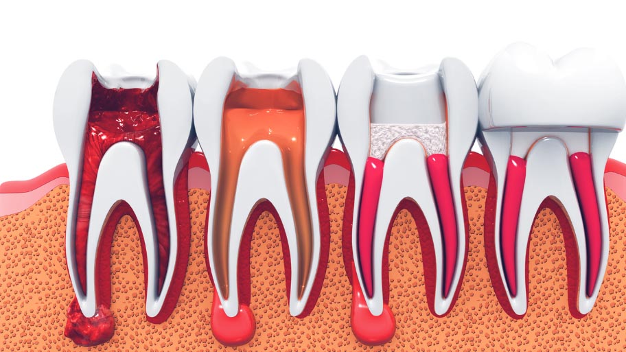 Save Your Tooth With Root Canal Therapy