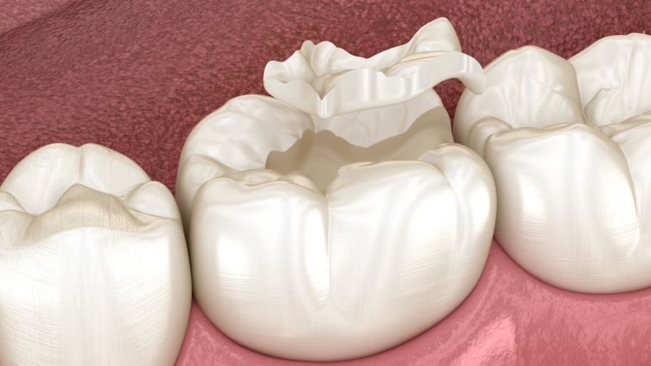 CEREC Crowns: The Fast-Track to a Flawless Smile