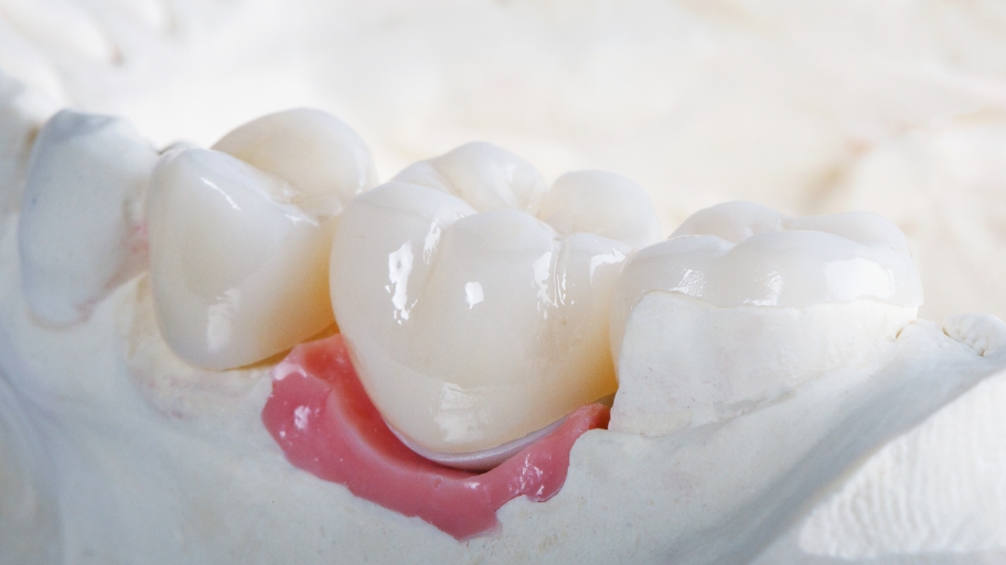 Benefits of Same Day Dental Crown